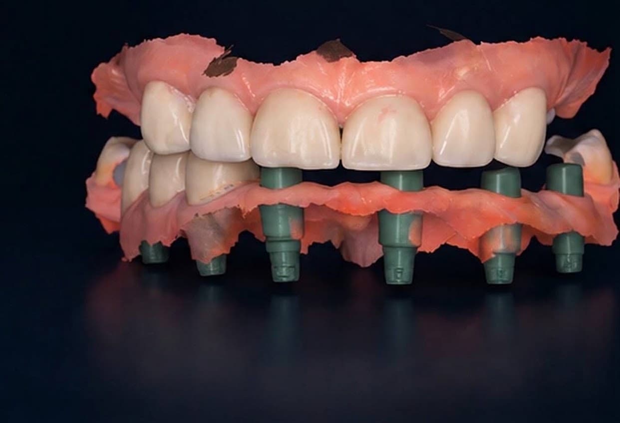 Full-Arch Rehabilitation